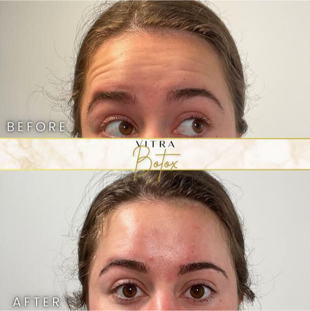 Botox before and after: smoother eye area