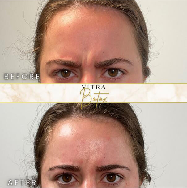 Botox before and after: softened frown lines