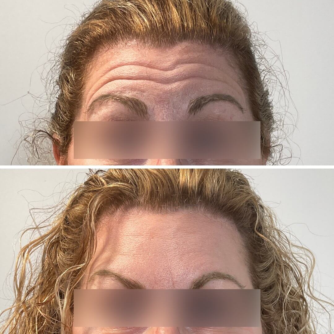 Botox before and after: smoother forehead