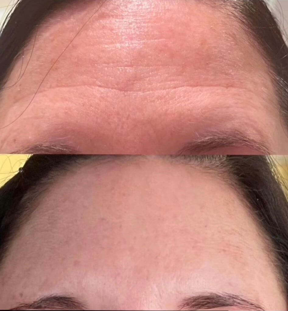 Botox before and after: relaxed forehead lines