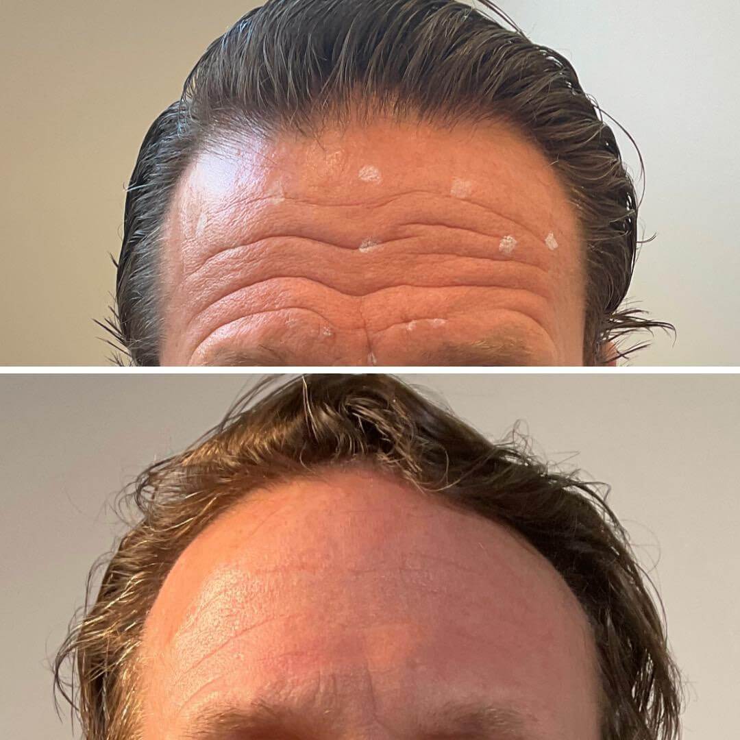 Botox before and after: smoother forehead for a male patient