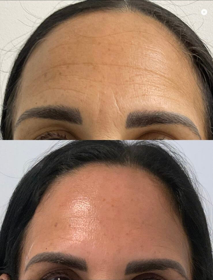 Botox before and after: softened horizontal forehead lines