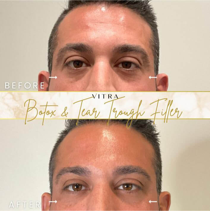 Botox and tear trough filler before and after