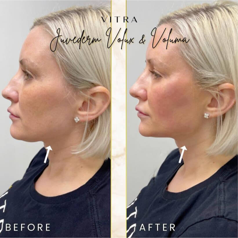 Juvéderm Volux and Voluma before and after