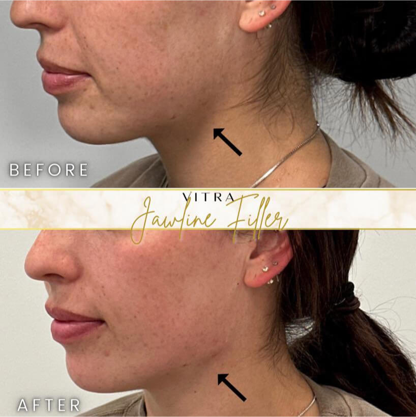 Jawline filler before and after
