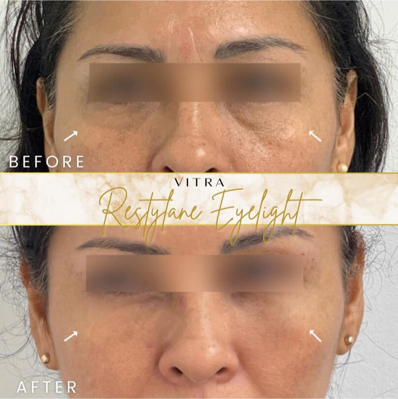 Restylane Eyelight before and after: brighter under-eyes