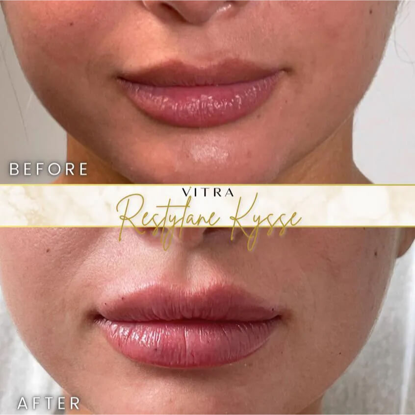 Restylane Kysse lip filler before and after