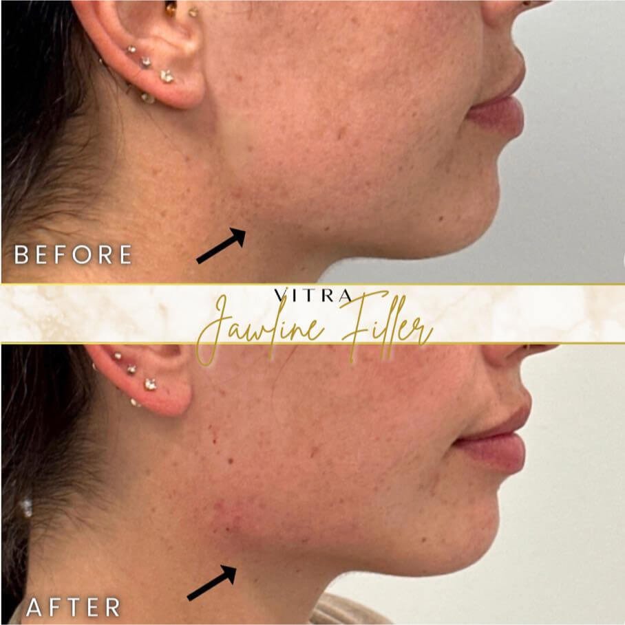 Jawline filler before and after: sharper contour