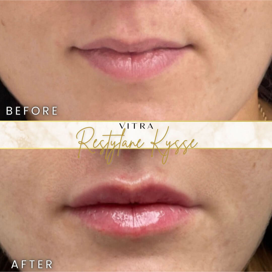 Restylane Kysse lip filler before and after
