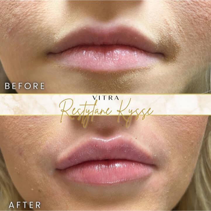 Restylane Kysse lip filler before and after