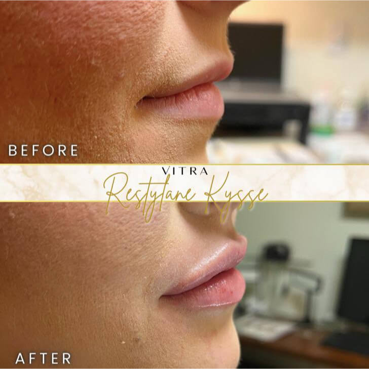 Restylane Kysse before and after: balanced lower face