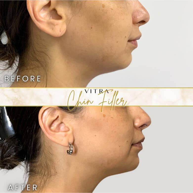 Chin filler before and after: improved profile