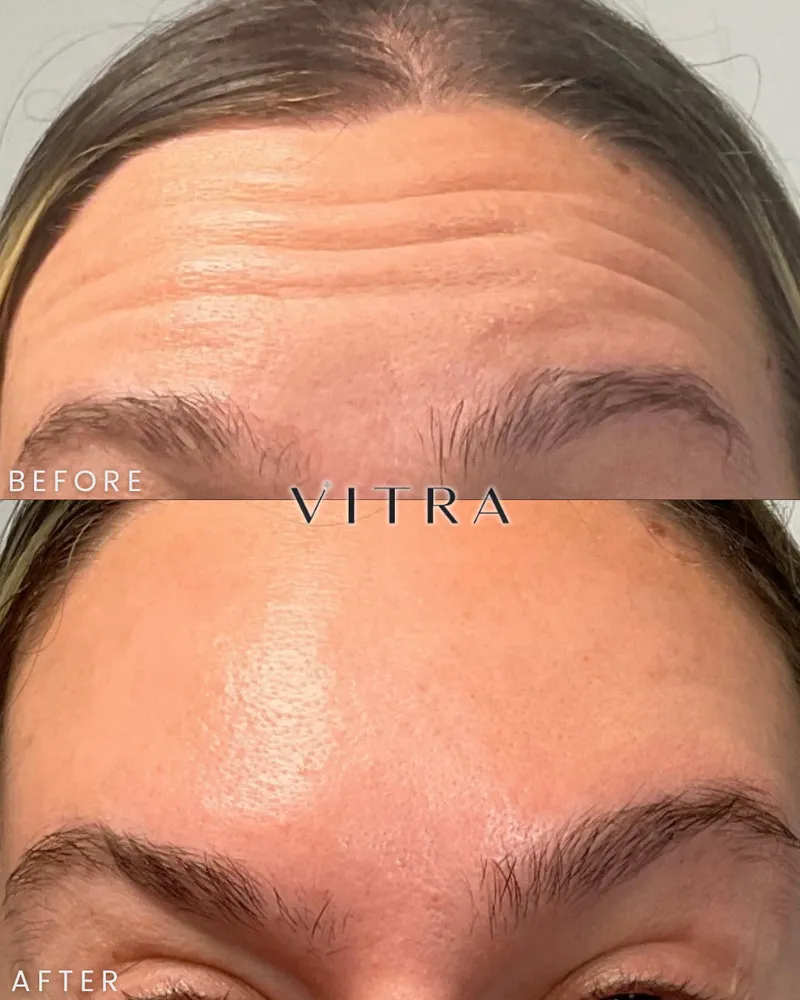 Botox before and after: smoother forehead lines