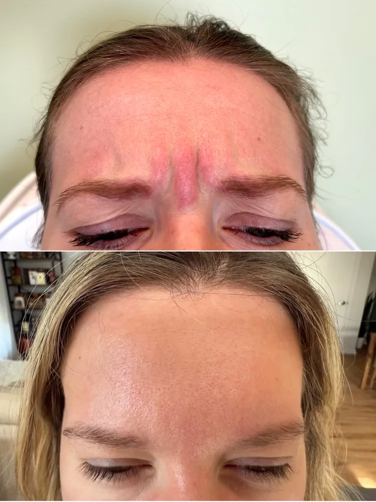 Botox before and after: reduced frown lines