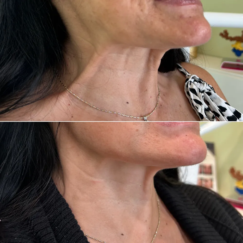 Botox before and after: softened neck bands and jawline