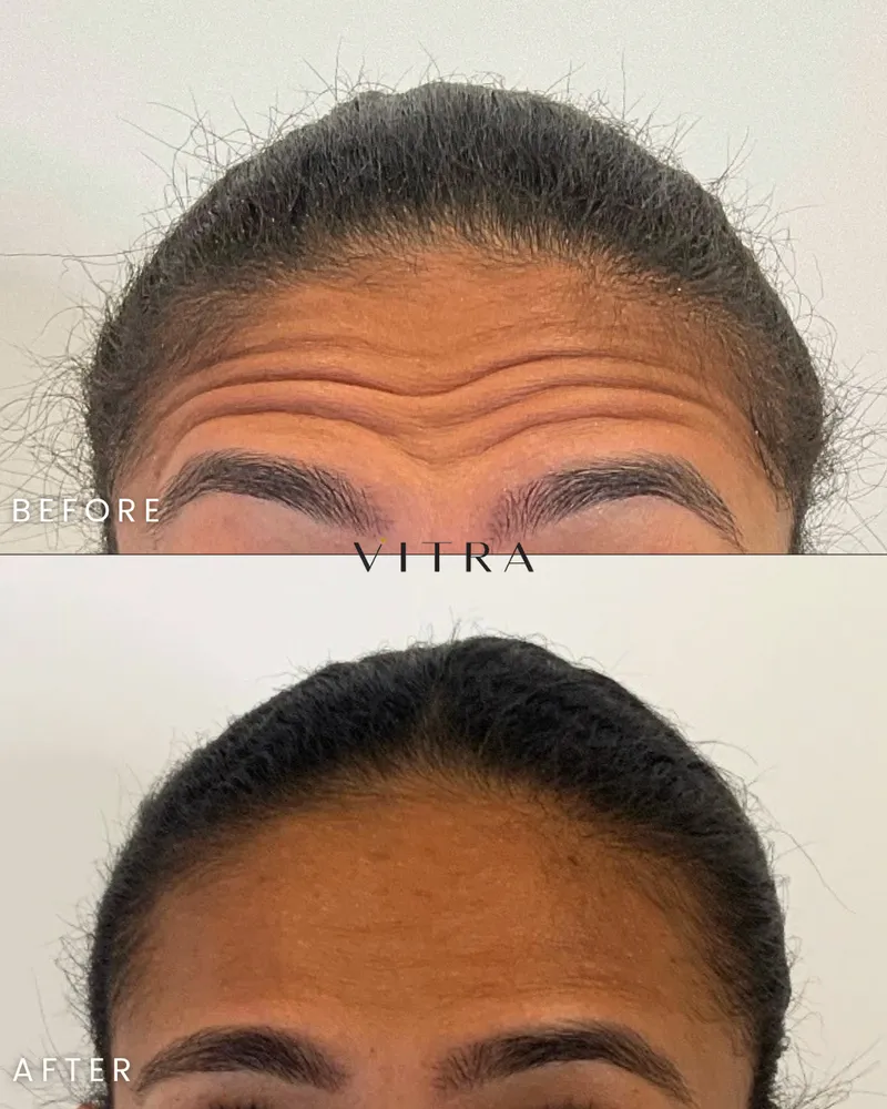 Dysport before and after: relaxed forehead