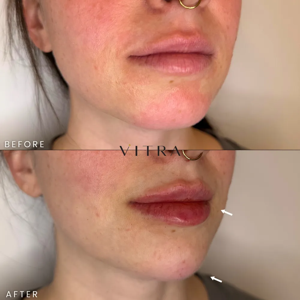 Restylane Kysse and Juvéderm Voluma before and after