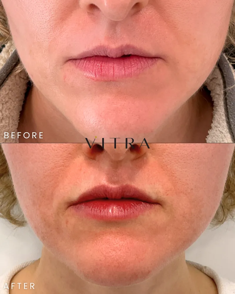 Lip filler before and after: fuller, balanced lips
