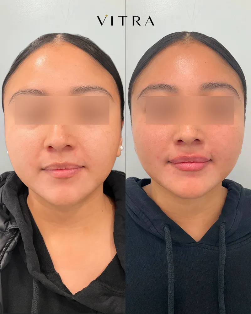Lip filler before and after: added volume and definition