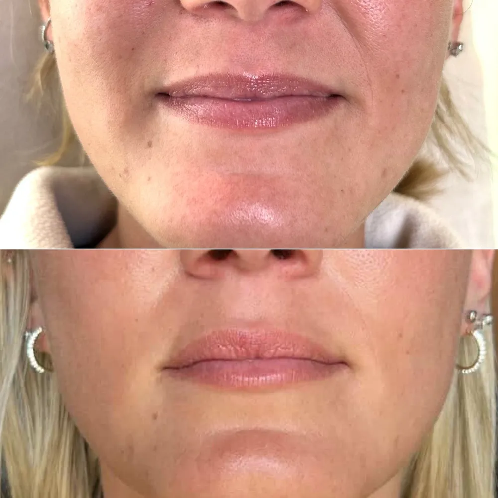 Lip filler before and after: softer lip border