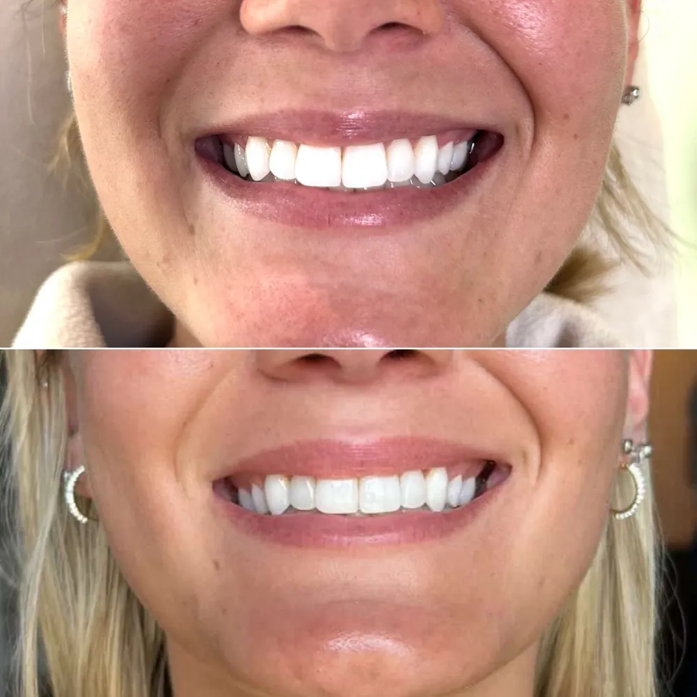 Lip filler before and after: improved lip shape