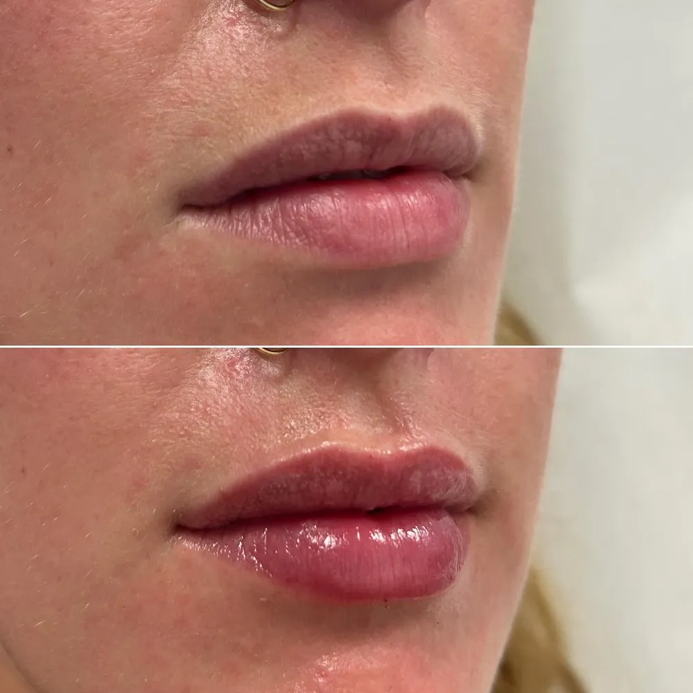 Lip filler before and after: natural-looking volume