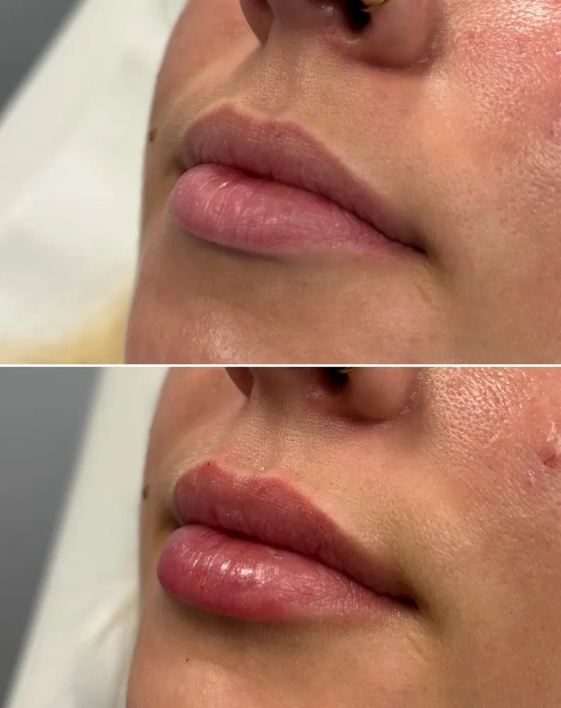 Lip filler before and after: refined lip proportions